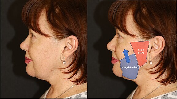 Wie wird die Anatomie des Gesichtes aus vergangenen Jahren mit dem extended Deep Plane Facelift wieder hergestellt?